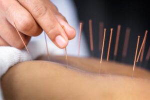 therapist placing needles in an acupuncture therapy program massachusetts 